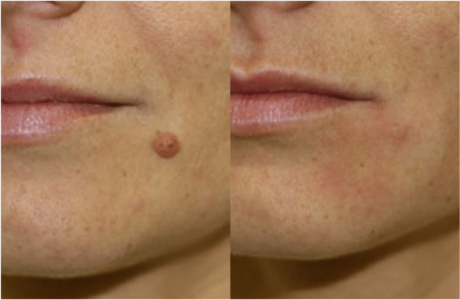 Enlever Les Grains De Beaut Au Laser Paris Dermatologue Esth Tique