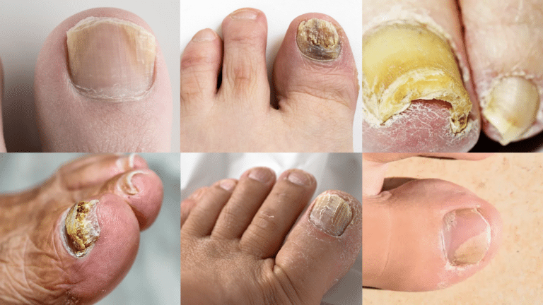 Mycoses des Ongles pieds et mains photos traitements symptômes et