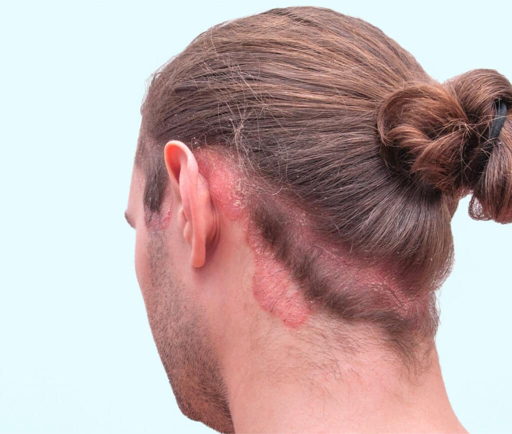 Psoriasis cuir chevelu causes et traitements Skin Marceau Paris