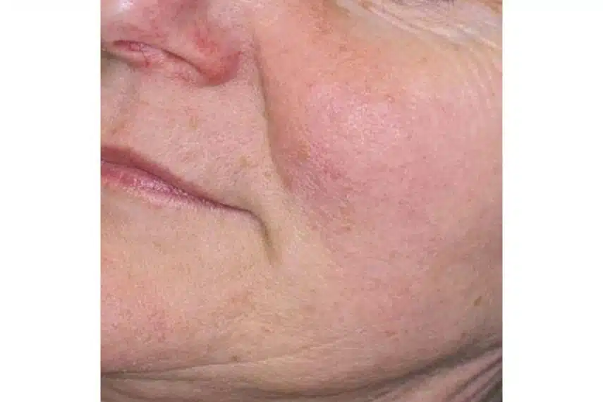 laser couperose après séance