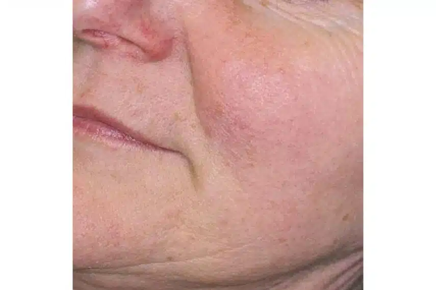 laser couperose après séance