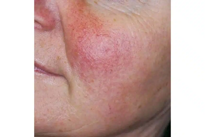 couperose laser - avant