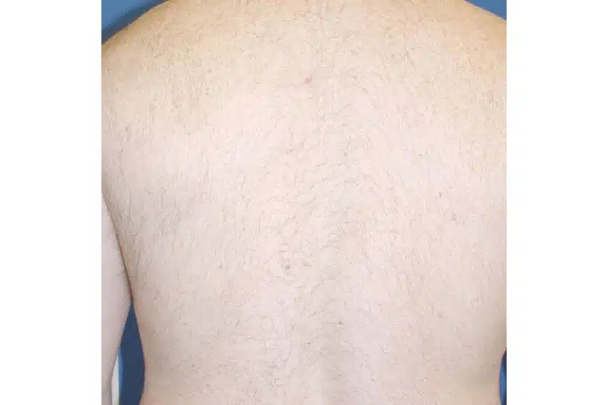 épilation définitive dos homme - après
