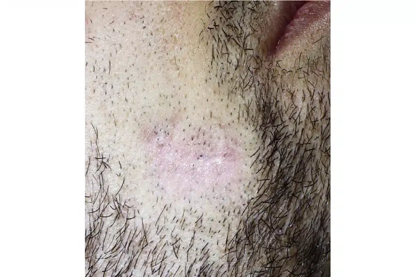 cicatrice apres joues