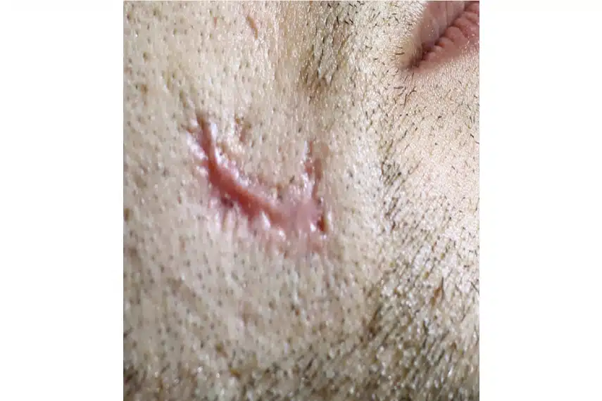 cicatrice avant joues