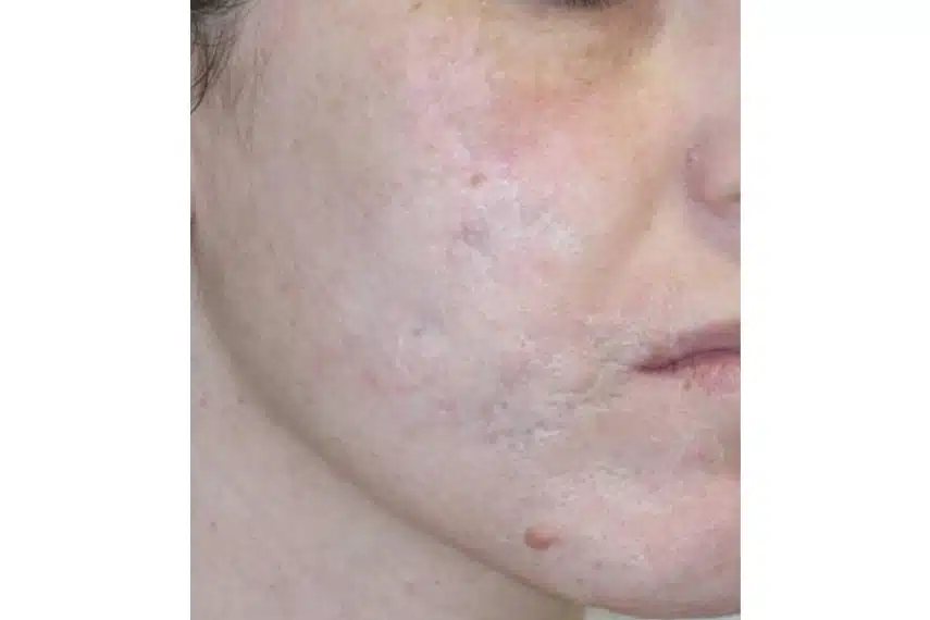 laser cicatrice acné avant après