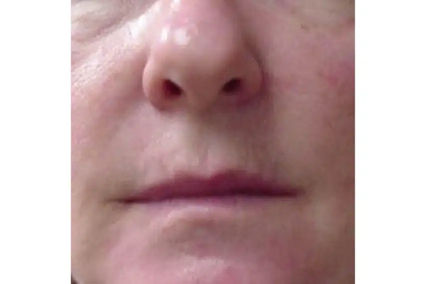 laser couperose resultats