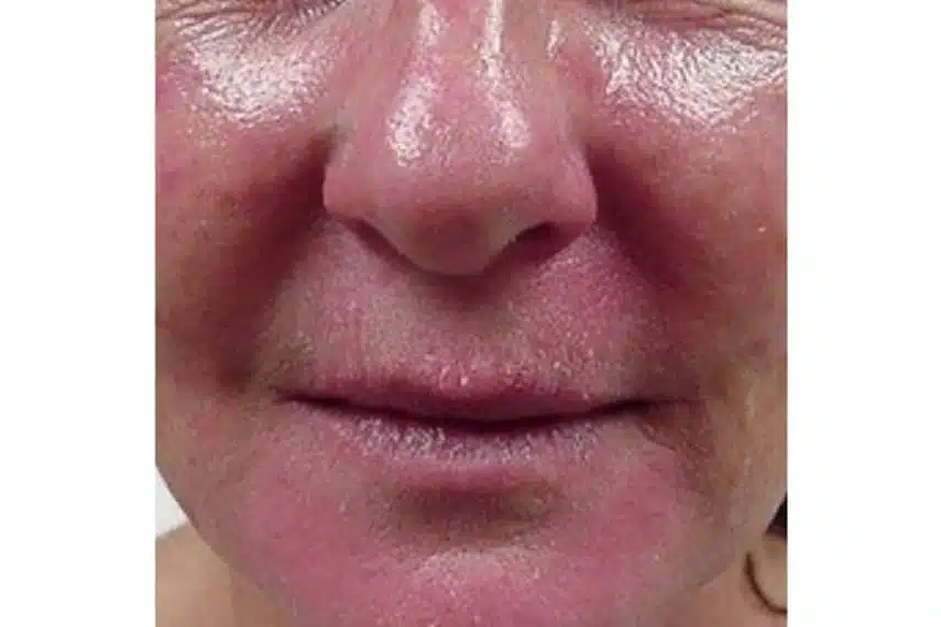 couperose traitement - avant