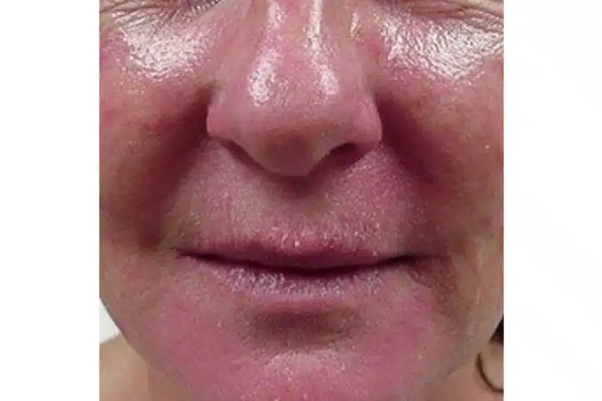 couperose traitement - avant