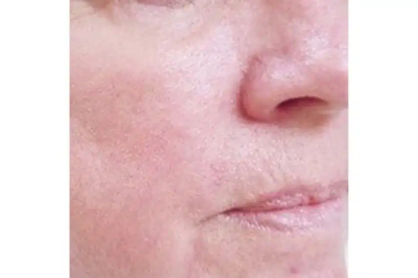 laser couperose - après