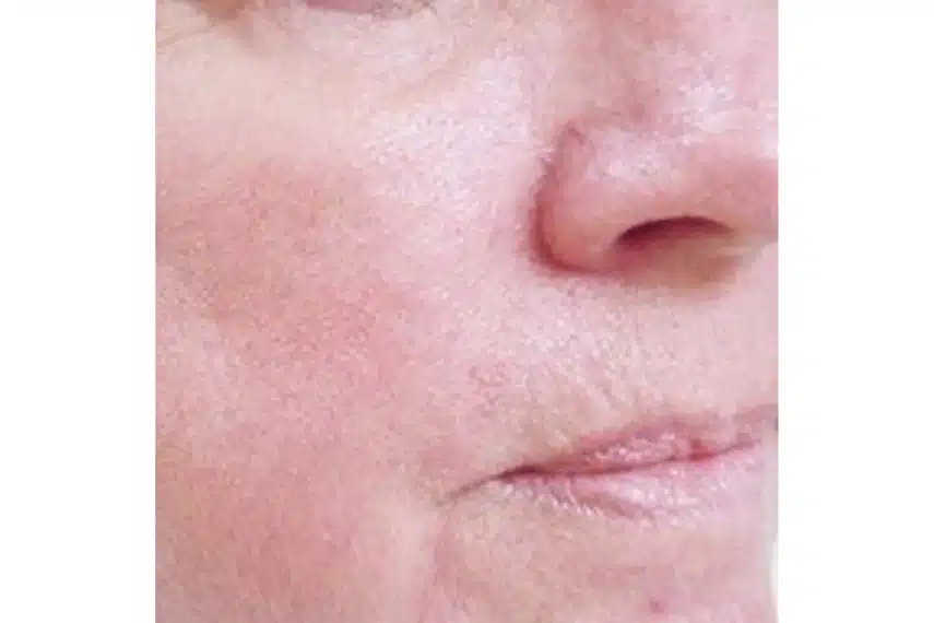 laser couperose - après