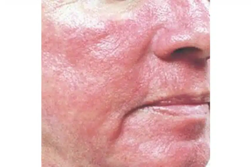 laser vasculaire visage - avant