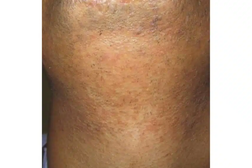 Epilation barbe homme - après