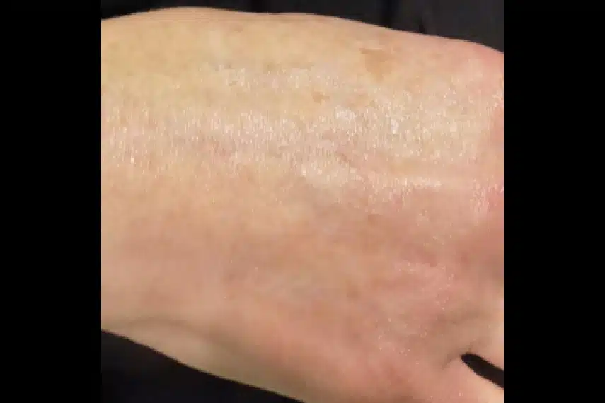 Traitement des taches brunes sur main - Après | Médecine esthétique | Clinique Skin Marceau Paris