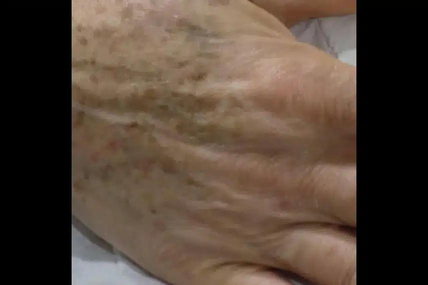 Taches brunes et laser main - Avant | Médecine esthétique | Clinique Skin Marceau Paris