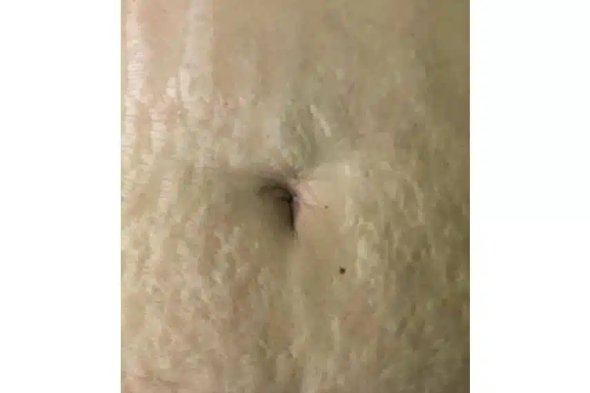 enlever vergetures laser avant après