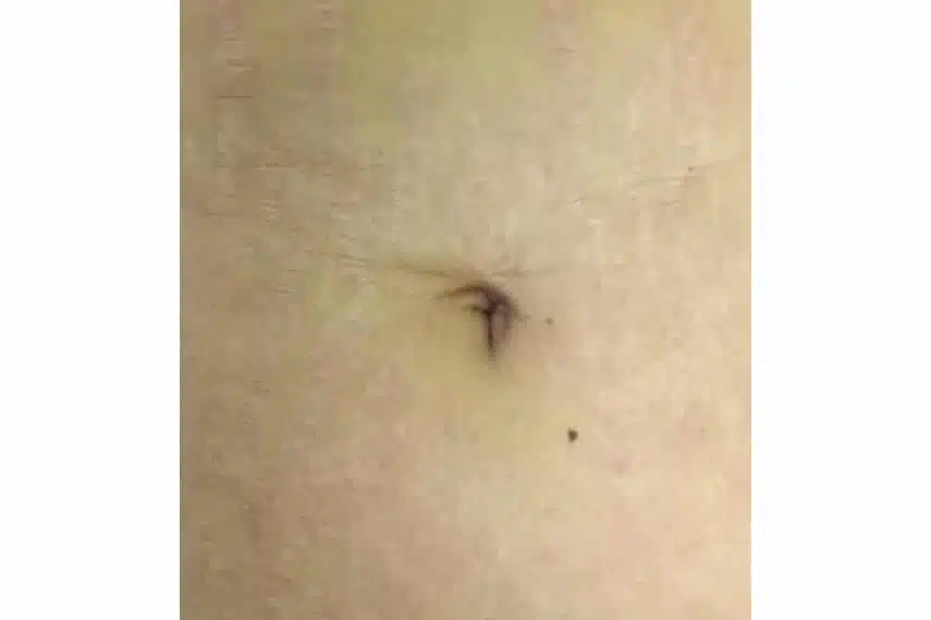 traitement vergetures laser avant après