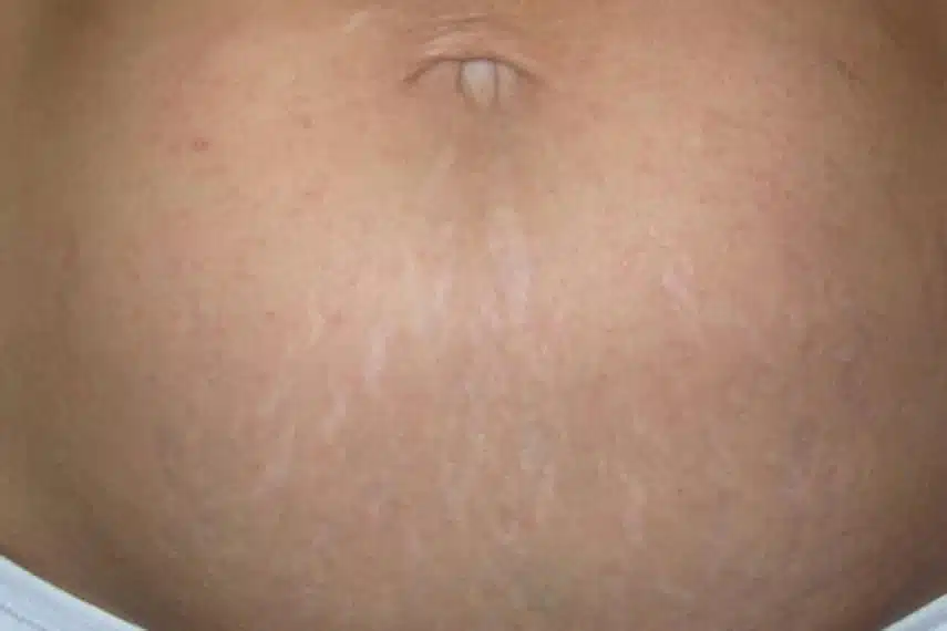 laser vergetures avant apres