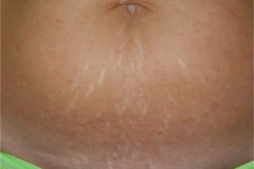 laser vergetures blanches avant apres