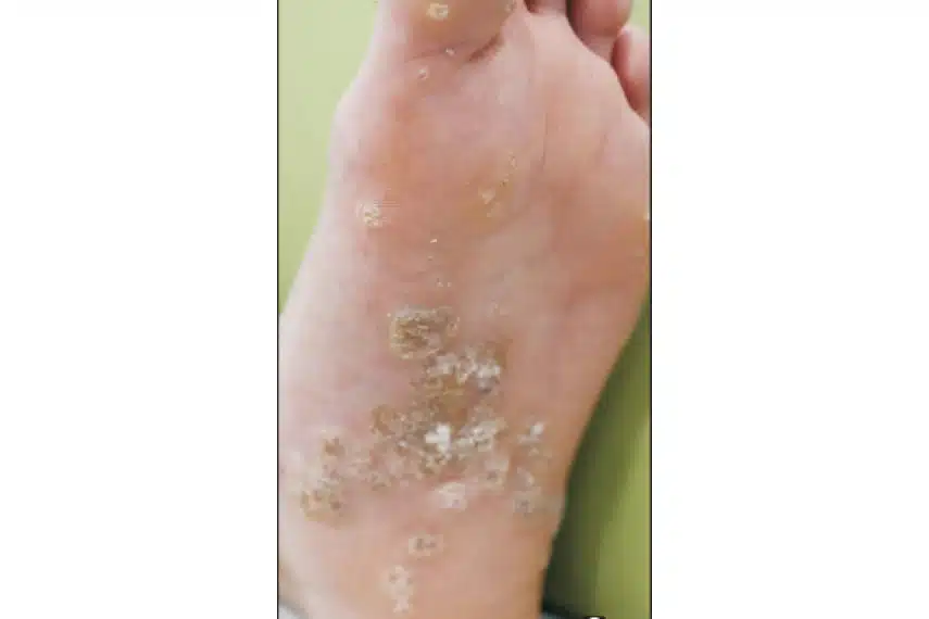 Verrue plantaire - Avant| Médecine esthétique | Clinique Skin Marceau Paris