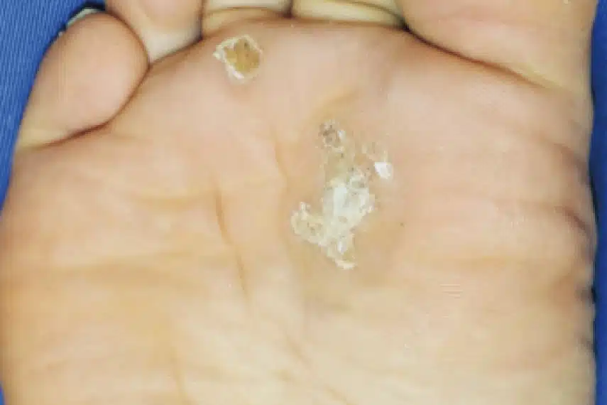 Enlever verrue pied - Avant | Médecine esthétique | Clinique Skin Marceau Paris