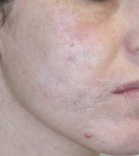 laser cicatrice acné avant après