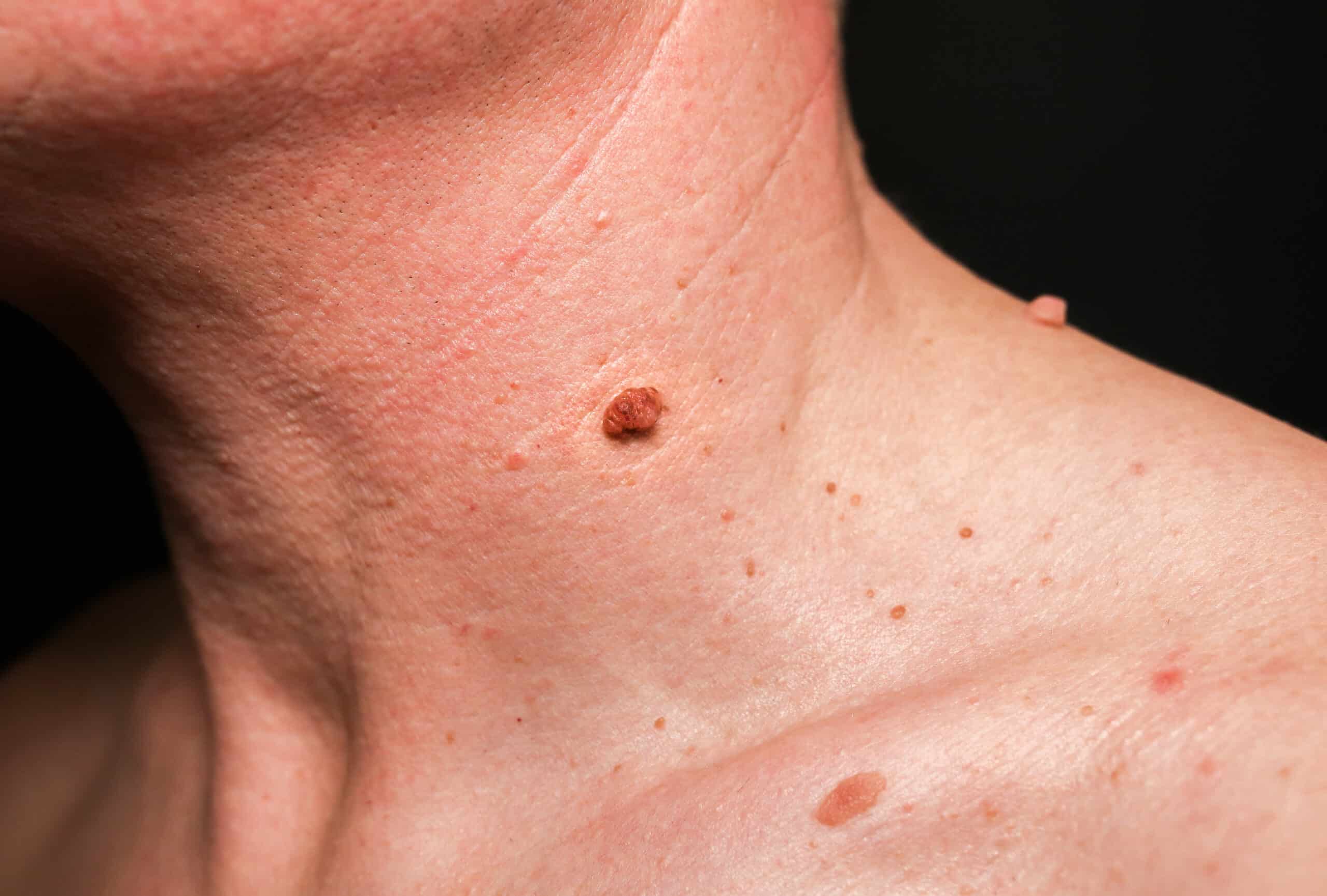 Verrue sur le cou | Dermatologue | Skin Marceau