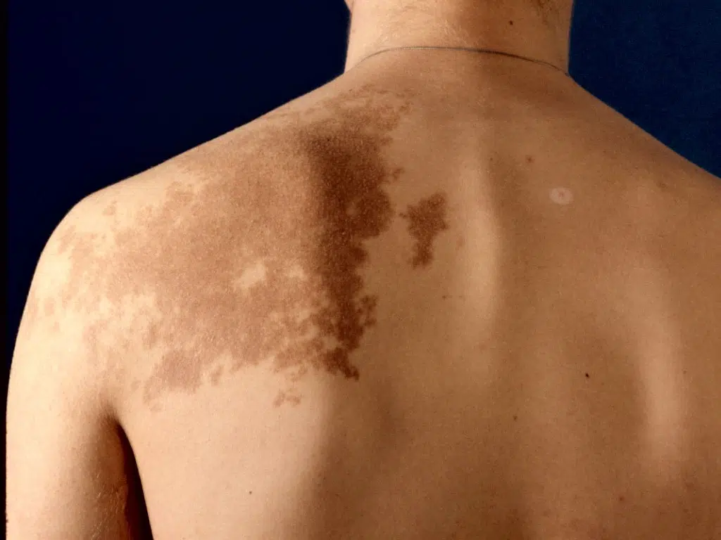 Nævus de Becker