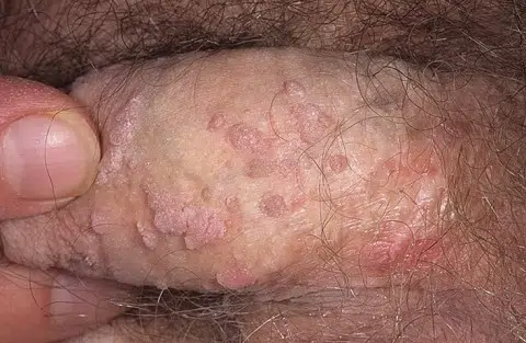 verrues-génitales-penis-condylomes
