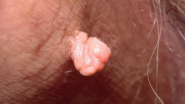 acrochordon-génitales-excroissance-verge-penis