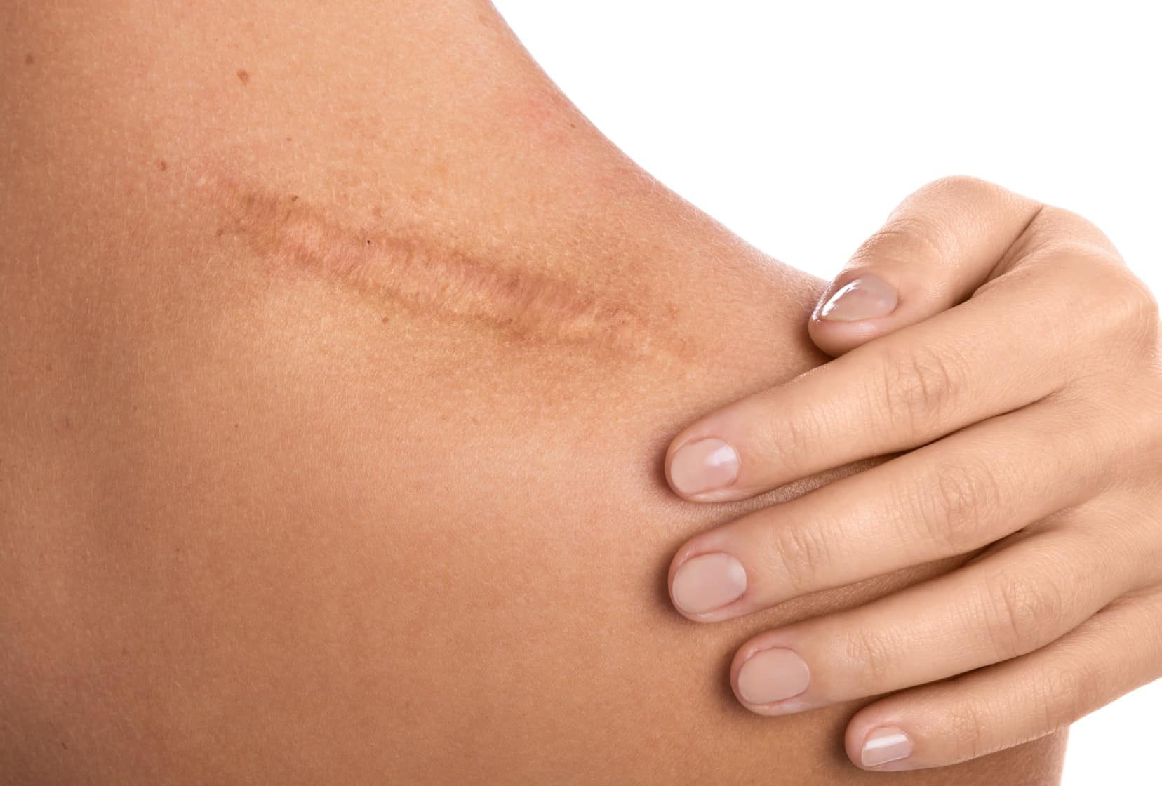 Comment traiter les cicatrices ? | Skin Marceau | Paris 16