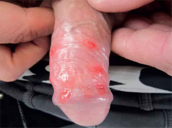 syphilis-homme-penis