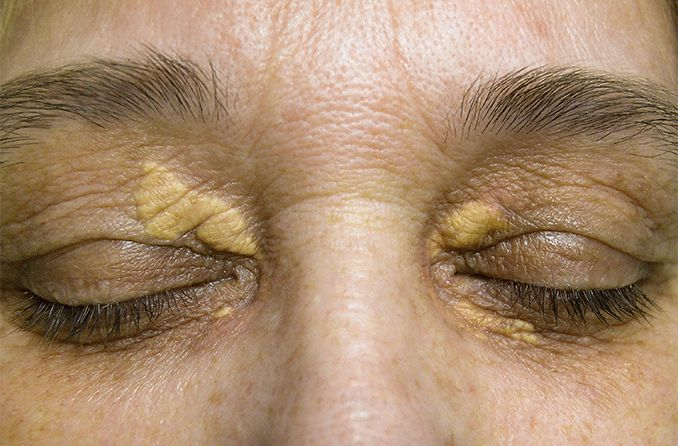 xanthelasma-orange-jaunâtre-xanthome