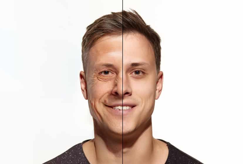 La blépharoplastie : découvrez l'âge idéal pour rajeunir votre regard avec l'expertise de Skin Marceau