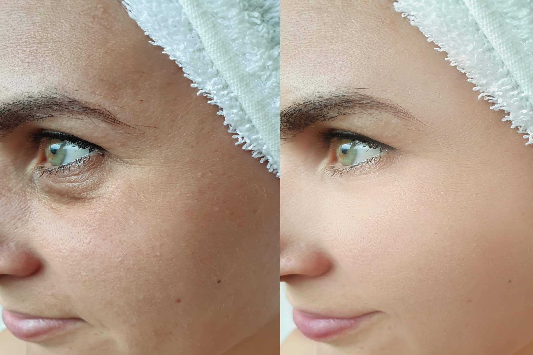 blepharoplastie intervention améliorer l'apparence de la peau des paupières