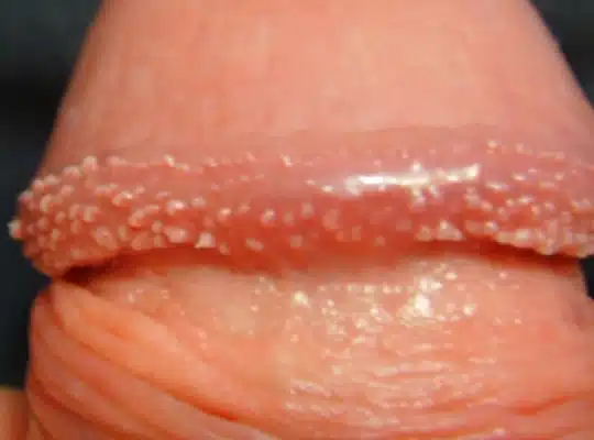 Boutons sur le gland 6