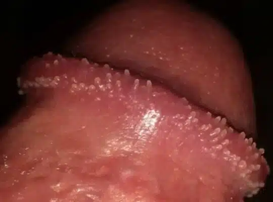 Boutons sur le gland 7