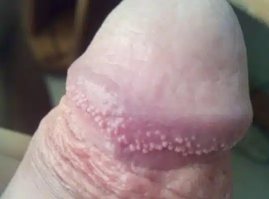 Boutons sur le gland 9