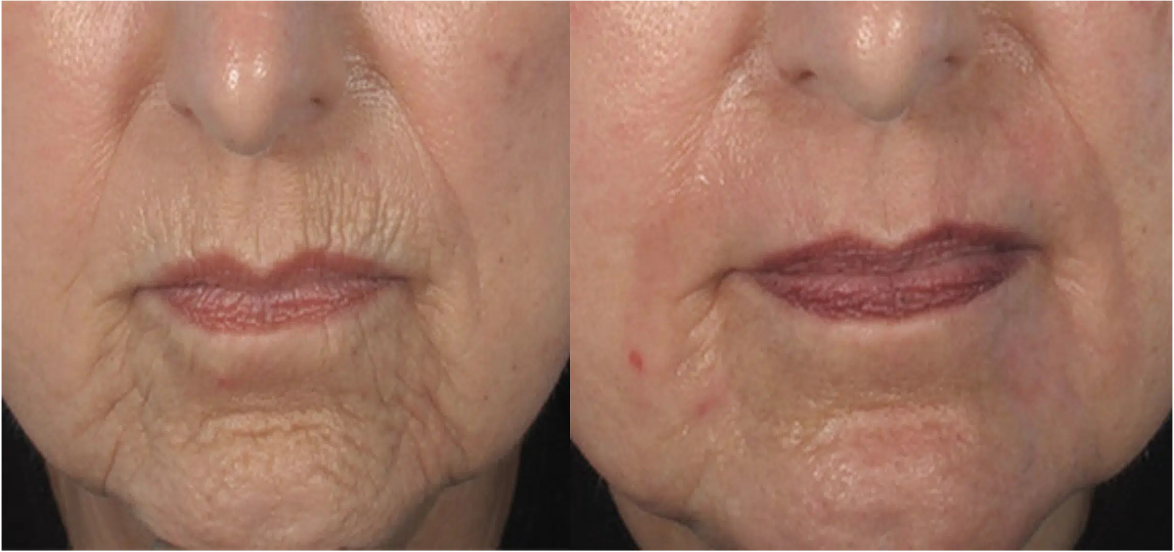 Rides autour de la bouche, rides du fumeur ou rides d'amertume avant apres