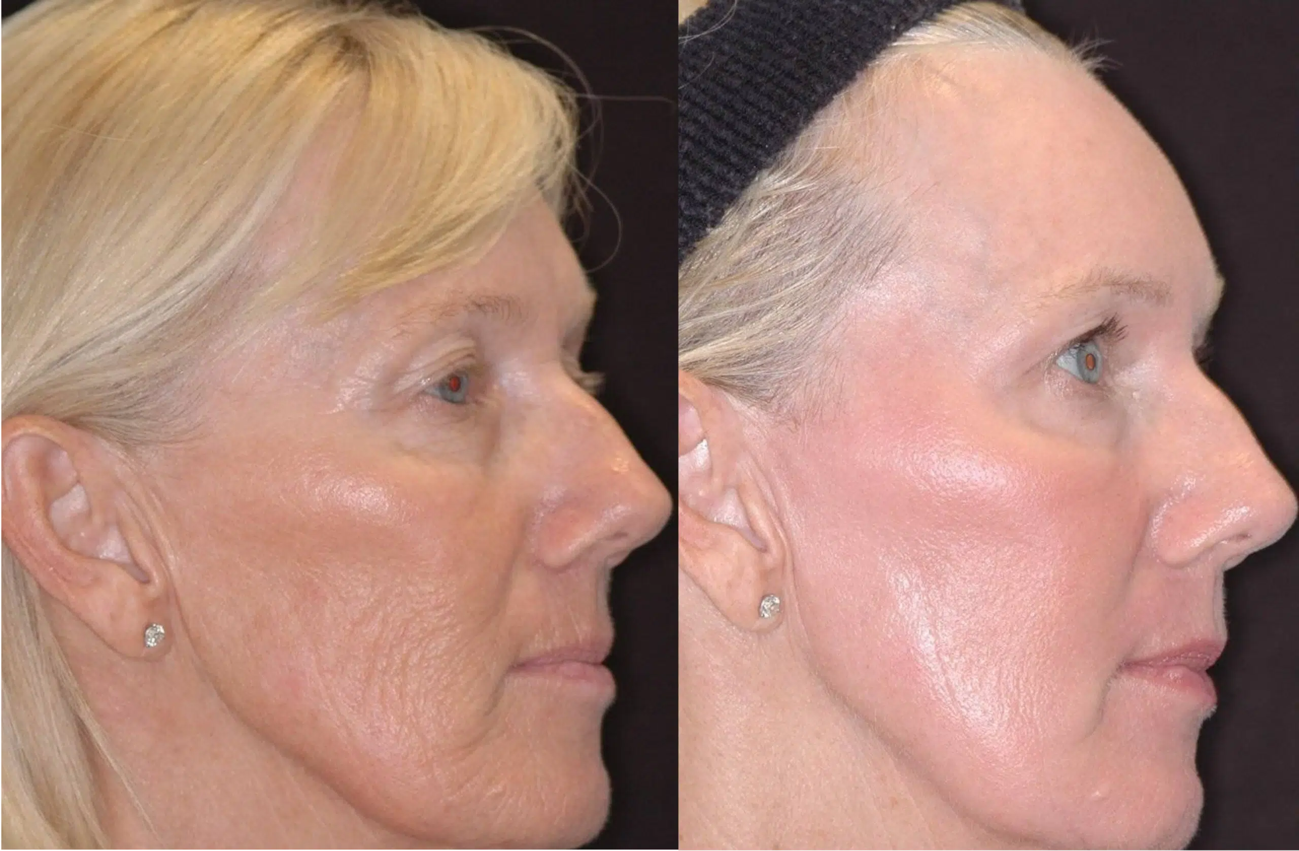 laser CO2 ablatif avant après Skin Marceau Paris