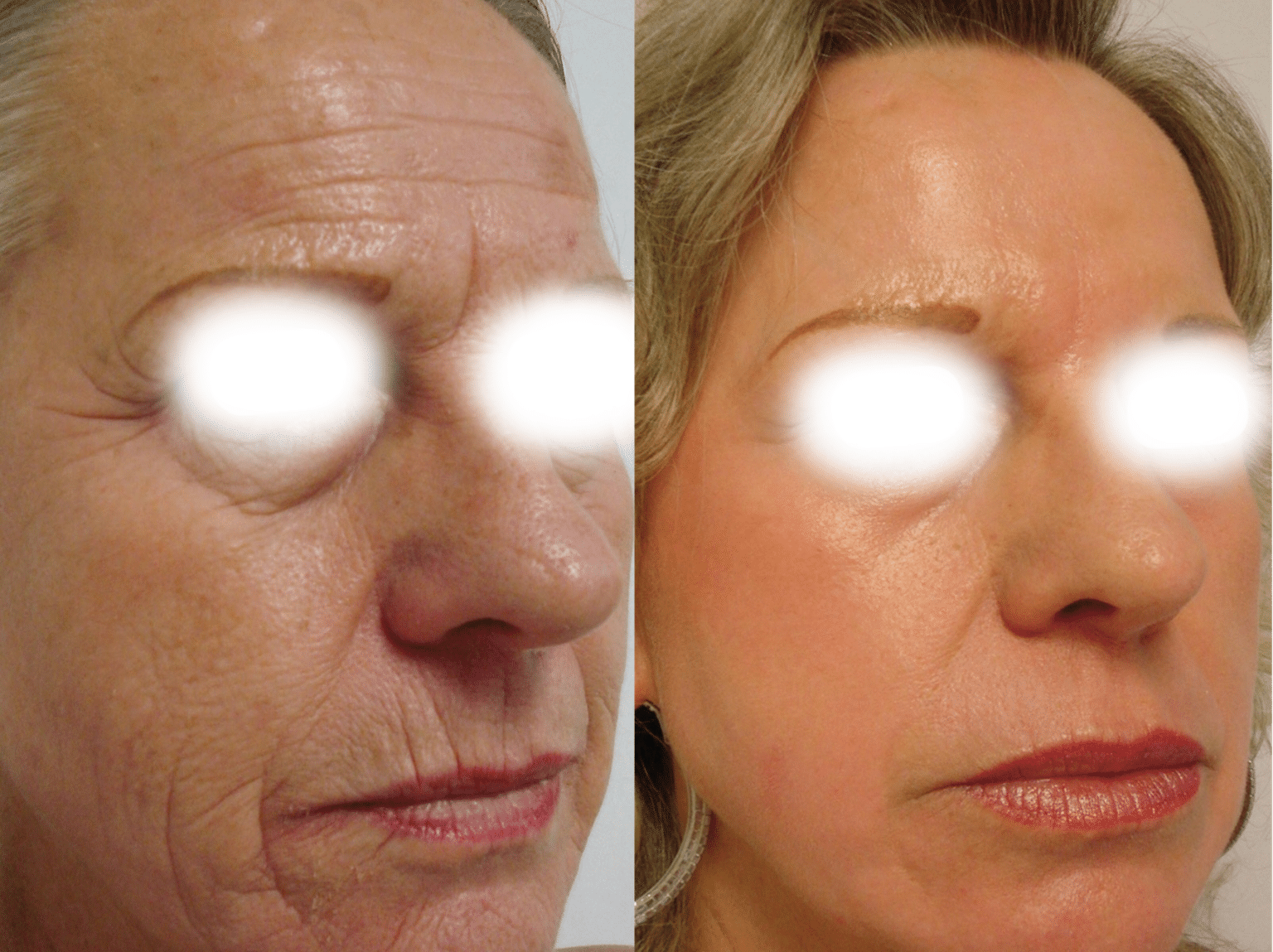 Prix du Laser CO2 Fractionné et ablatif Resurfaçage du visage