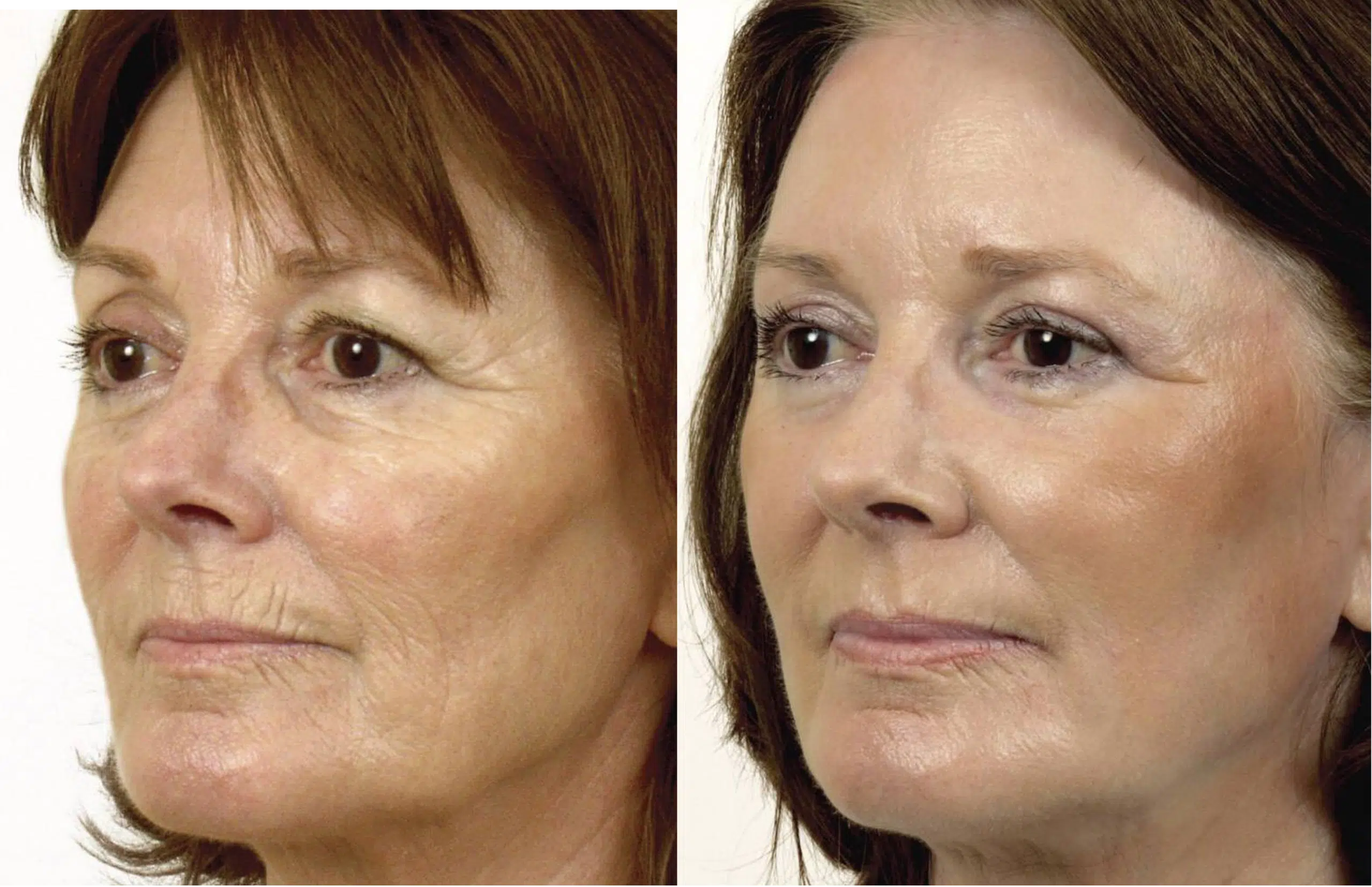 laser CO2 fractionné avant après Skin Marceau Paris