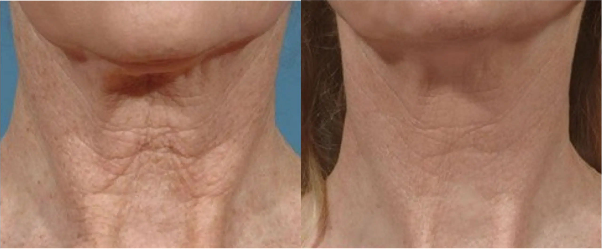 laser CO2 fractionné avant apres cou