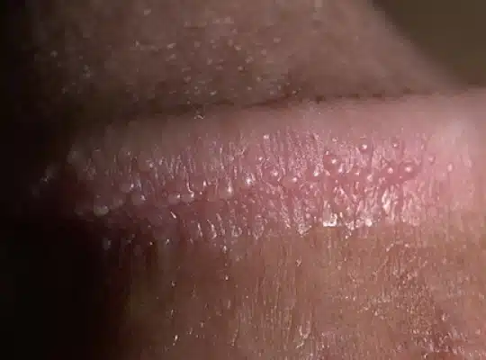 Boutons sur le gland 1