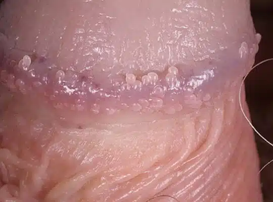 Boutons sur le gland 3