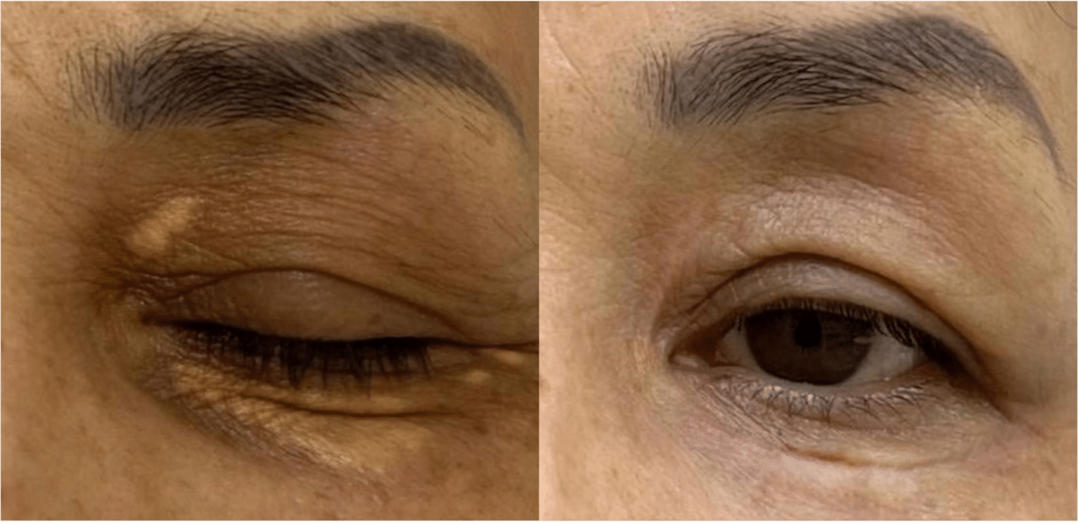 Laser CO2 Avant Après Dermatologue Esthétique Skin Marceau