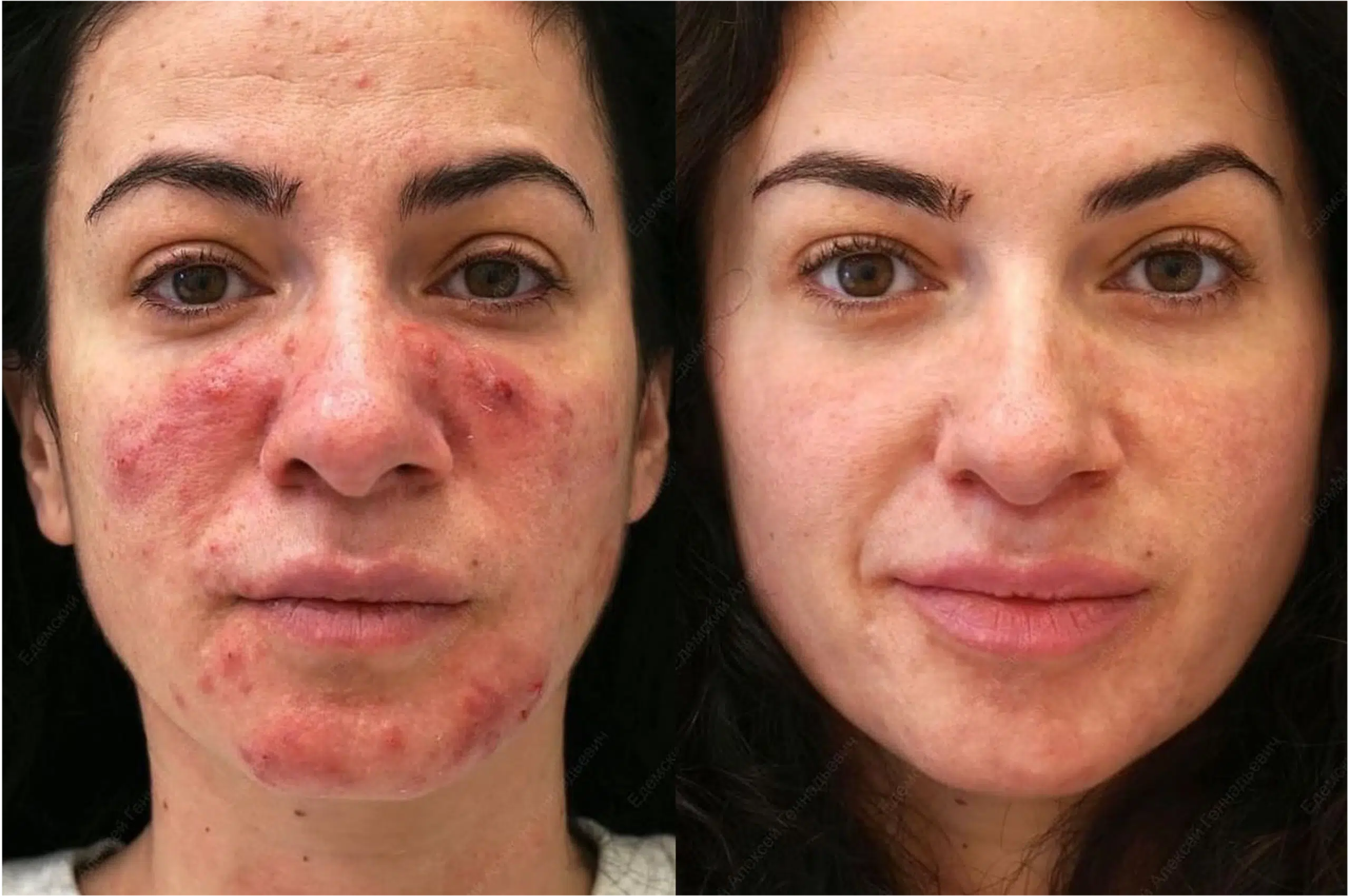 Couperose laser avant après