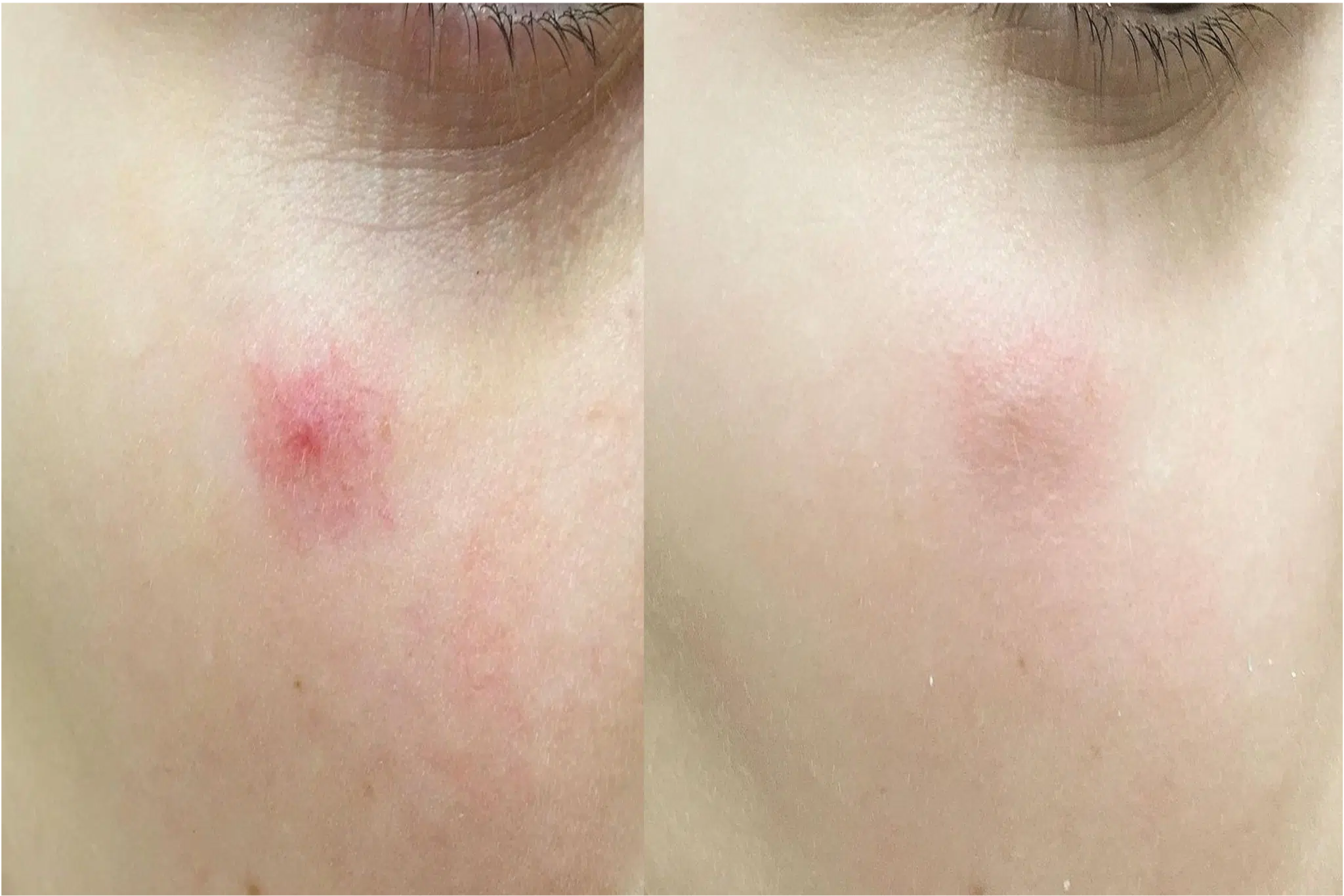 angiome stellaire traitement avant apres Paris Skin Marceau