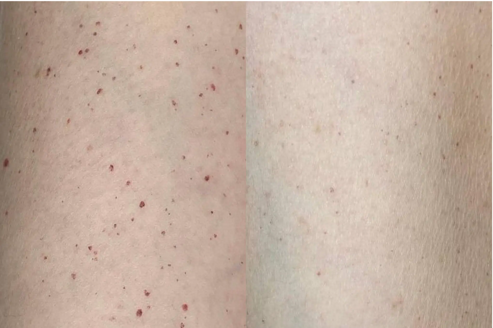 angiome petechie traitement avant apres Paris Skin Marceau
