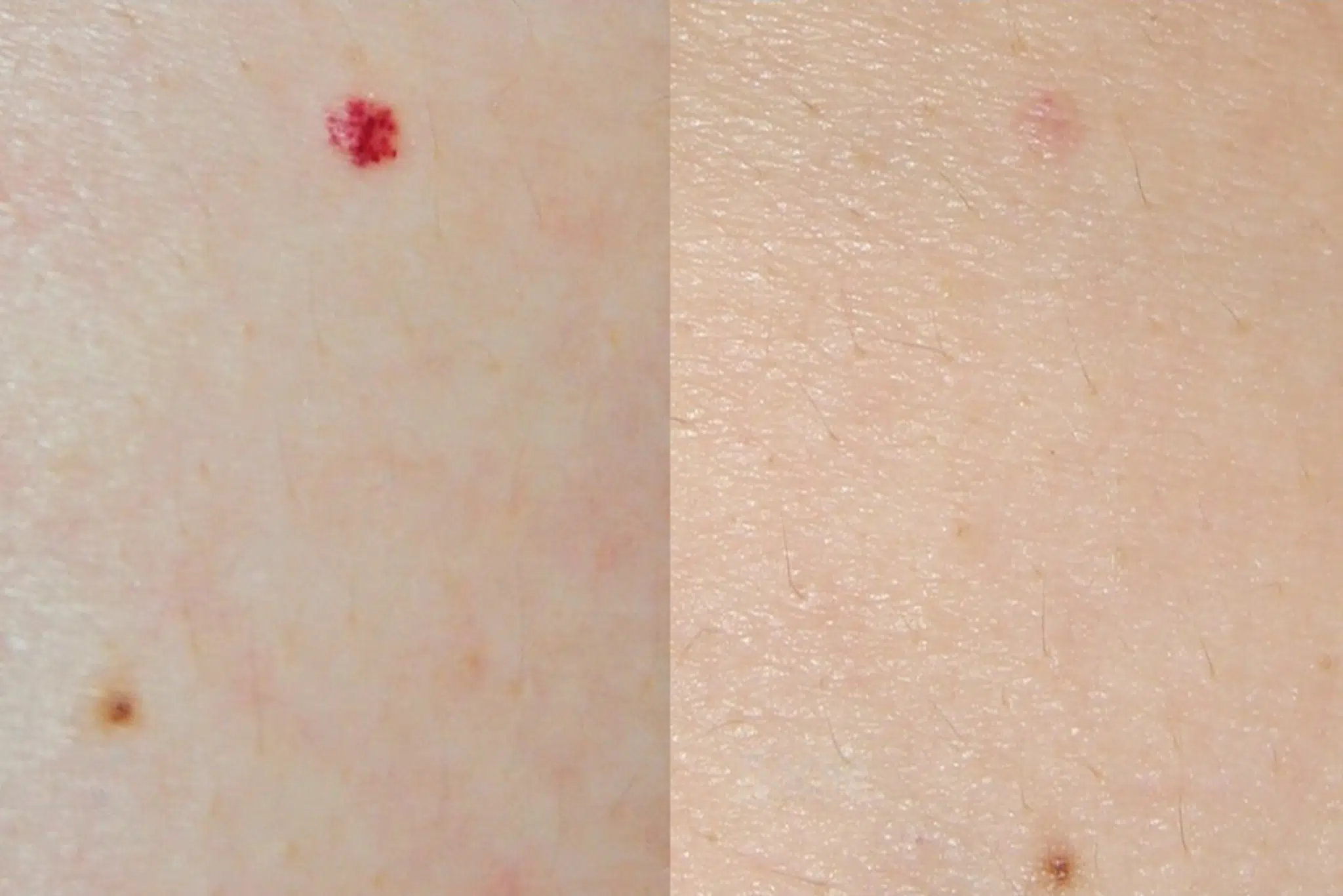 angiome rubis traitement avant apres Paris Skin Marceau